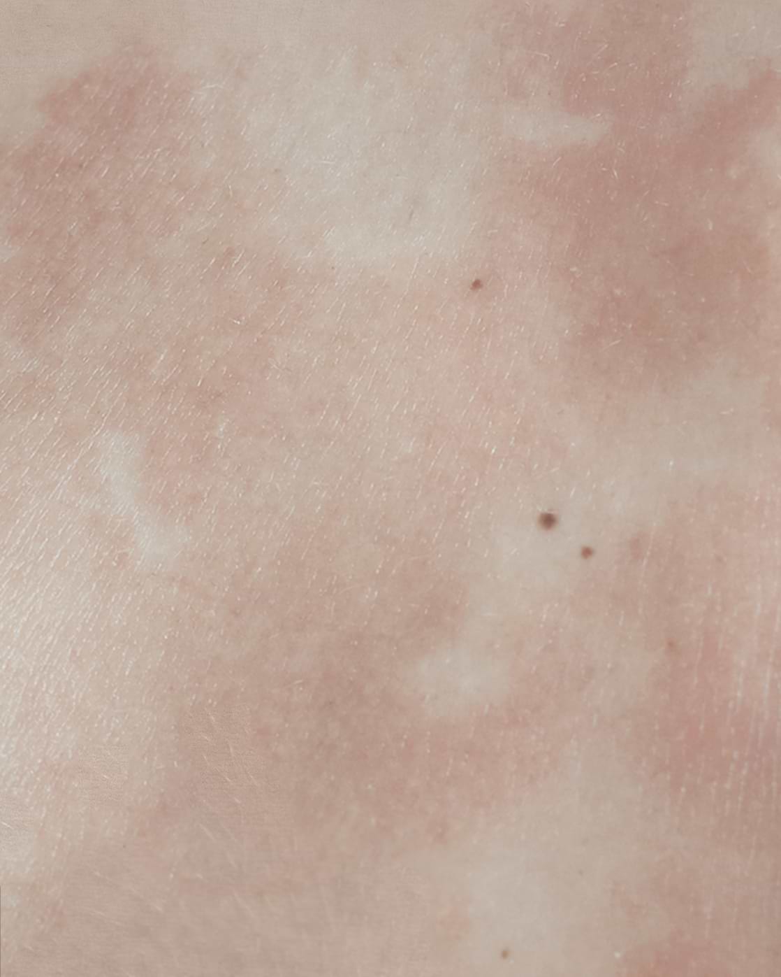 Atopic Dermatitis: Symptoms, Causes and Solutions. — Typology