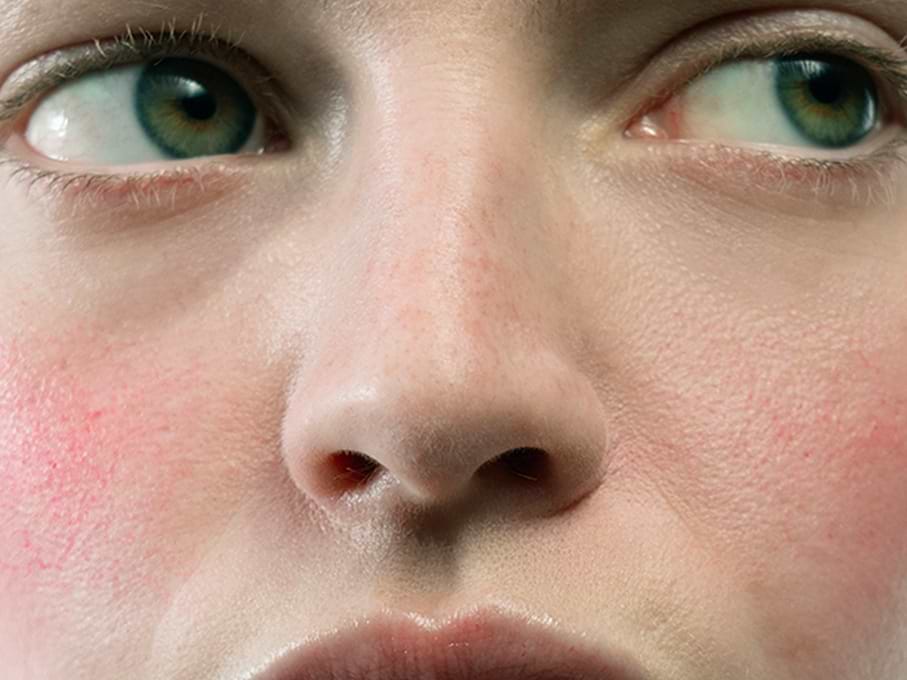 Winter: Why does the cold turn the skin red? — Typology
