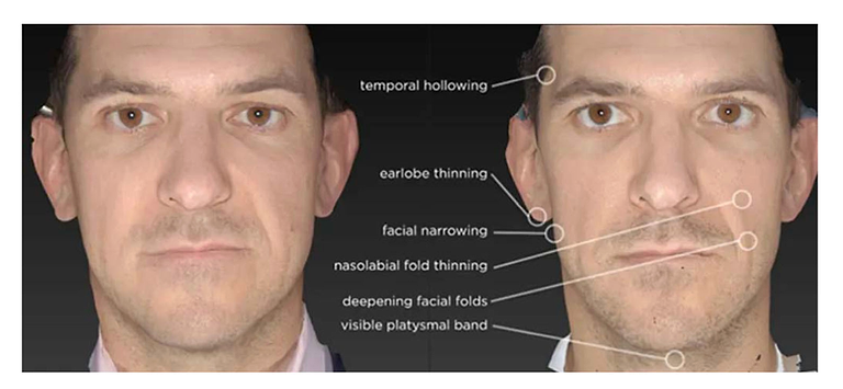 does semaglutide dry out your skin Dermal Hypersensitivity Reaction to Semaglutide: Two Case Reports Ozempic Face: The Saggy Side
