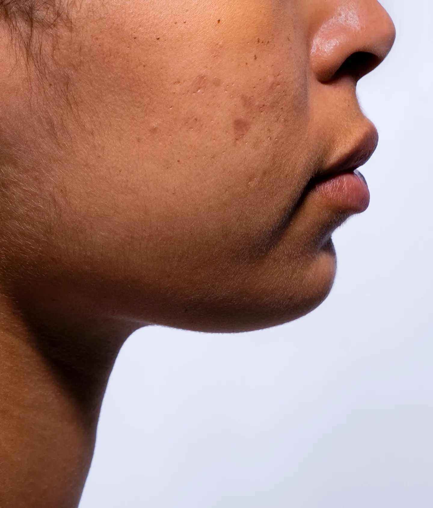 does glutathione remove scars can Injection: Benefits, Safety, & What To Expect Glutathione Skin Brightening Results Alternatives to topical treatments for