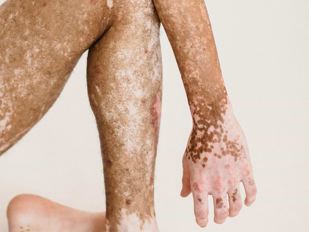 glutathione vitiligo PDF] Erythrocyte malondialdehyde and levels in patients How much progress has been