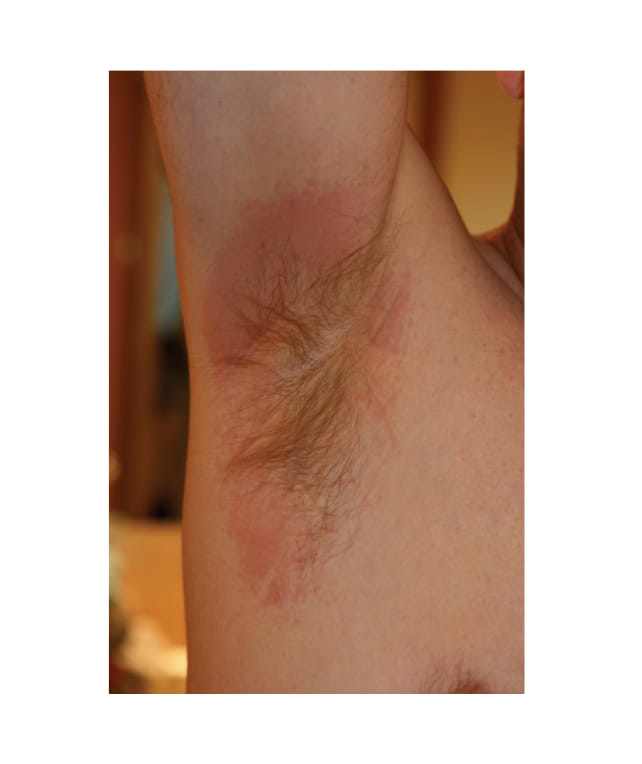 Deodorants and antiperspirants: what about aluminum salts? — Typology