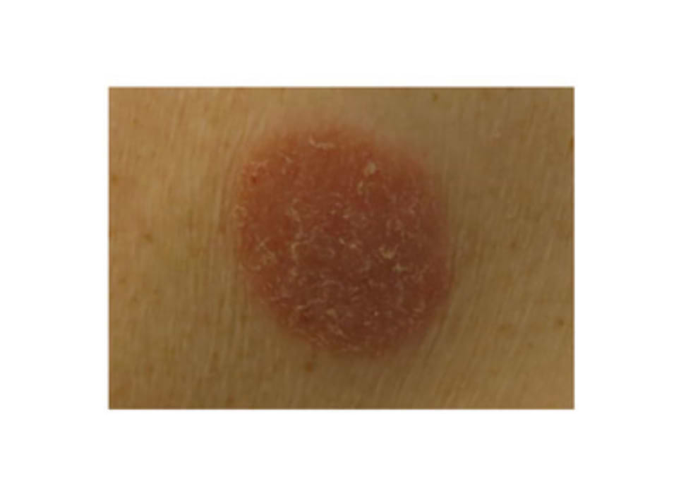 How to identify and treat a skin fungus? — Typology